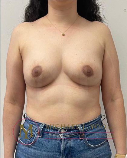 Areola Reduction Before & After Patient #4147