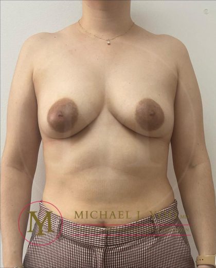 Areola Reduction Before & After Patient #4147