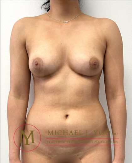 Areola Reduction Before & After Patient #4148