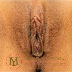 Labiaplasty Before & After Patient #4145