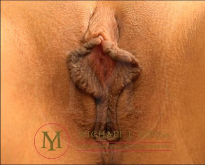 Labiaplasty Before & After Patient #4145