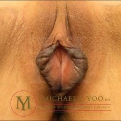 Labiaplasty Before & After Patient #4146