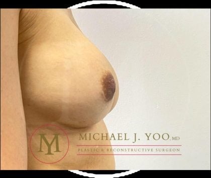 Nipple Reduction Before & After Patient #4144