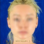 Otoplasty Before & After Patient #4142