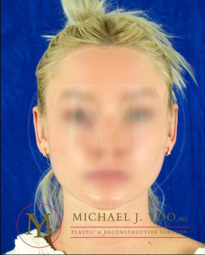 Otoplasty Before & After Patient #4142