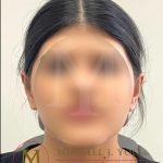 Otoplasty Before & After Patient #4143