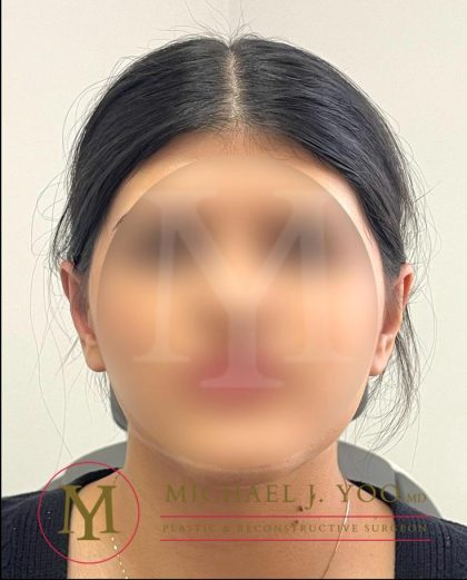 Otoplasty Before & After Patient #4143