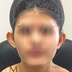 Otoplasty Before & After Patient #4143