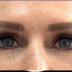 Upper Eyelid Lift Before & After Patient #4149