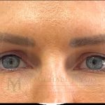 Upper Eyelid Lift Before & After Patient #4149