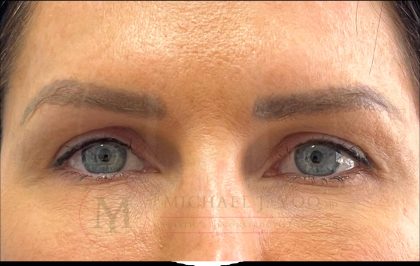 Upper Eyelid Lift Before & After Patient #4149