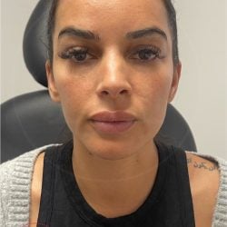 Forehead Reduction Before & After Patient #4156