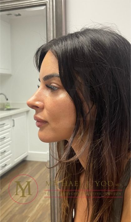 Rhinoplasty Before & After Patient #4168