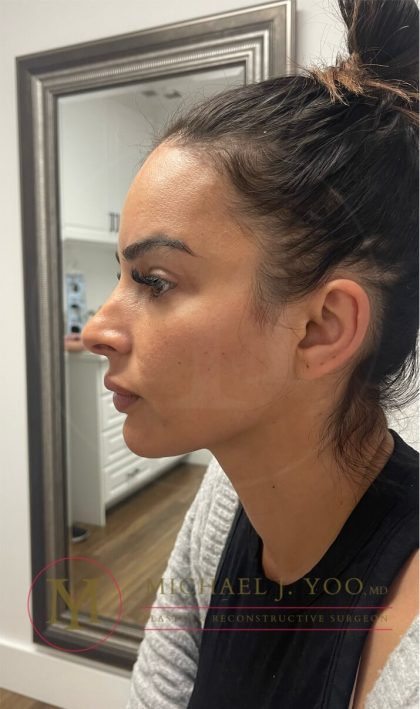 Rhinoplasty Before & After Patient #4168