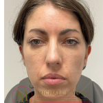 Lower Eyelid Lift Before & After Patient #4177