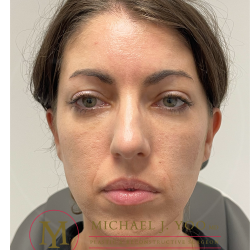 Lower Eyelid Lift Before & After Patient #4177