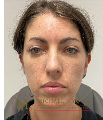 Lower Eyelid Lift Before & After Patient #4177