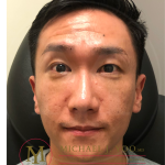 Lower Eyelid Lift Before & After Patient #4180