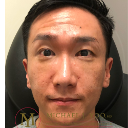 Lower Eyelid Lift Before & After Patient #4180