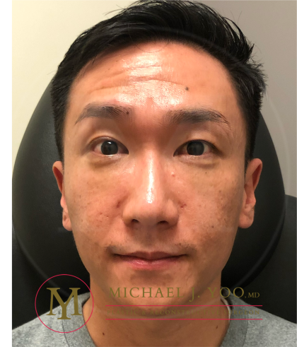 Lower Eyelid Lift Before & After Patient #4180