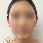 Otoplasty Before & After Patient #4183