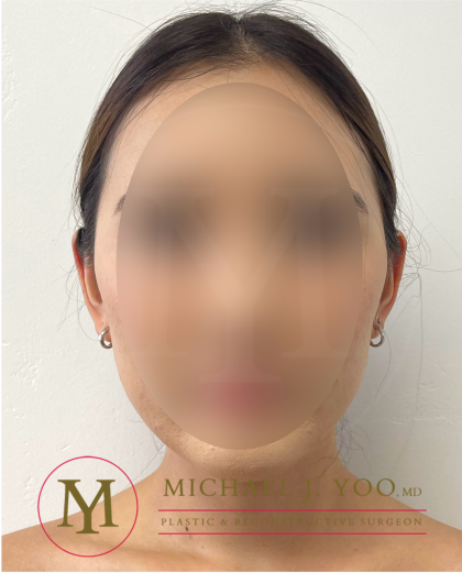 Otoplasty Before & After Patient #4183