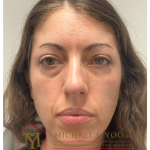 Lower Eyelid Lift Before & After Patient #4177