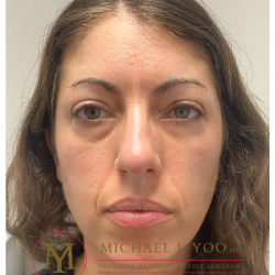 Lower Eyelid Lift Before & After Patient #4177