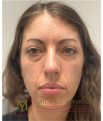 Lower Eyelid Lift Before & After Patient #4177