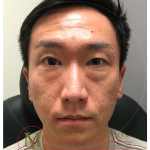 Lower Eyelid Lift Before & After Patient #4180