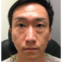 Lower Eyelid Lift Before & After Patient #4180
