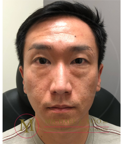 Lower Eyelid Lift Before & After Patient #4180