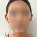 Otoplasty Before & After Patient #4183