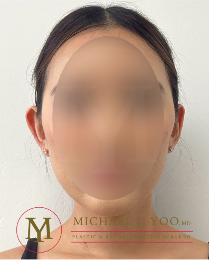 Otoplasty Before & After Patient #4183