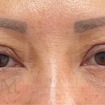 Lower Eyelid Lift Before & After Patient #4202