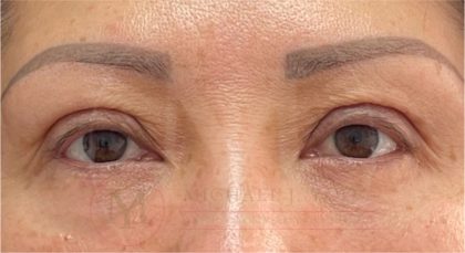 Lower Eyelid Lift Before & After Patient #4202