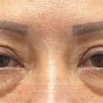 Lower Eyelid Lift Before & After Patient #4202