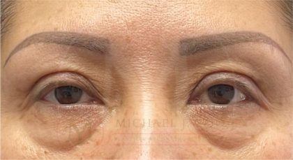 Lower Eyelid Lift Before & After Patient #4202