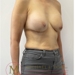 Breast Lift with Implants Before & After Patient #4228