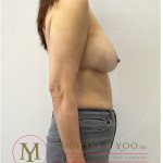 Breast Lift with Implants Before & After Patient #4228