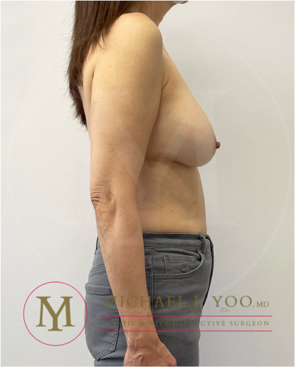 Breast Lift with Implants Before & After Patient #4228