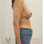 Breast Lift with Implants Before & After Patient #4228