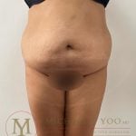 Tummy Tuck Before & After Patient #4253