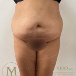 Tummy Tuck Before & After Patient #4253