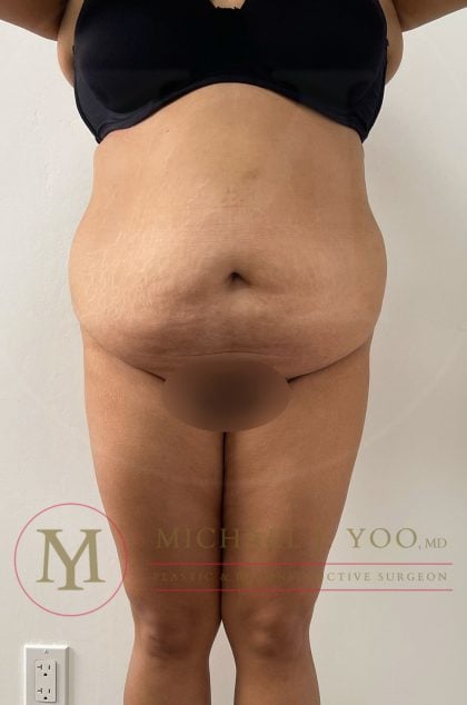 Tummy Tuck Before & After Patient #4253