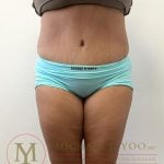 Tummy Tuck Before & After Patient #4253