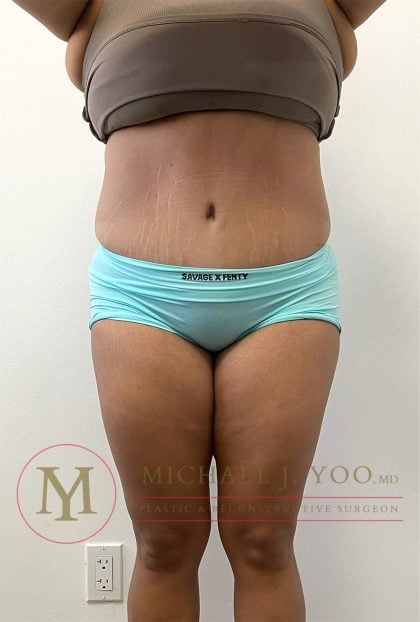 Tummy Tuck Before & After Patient #4253