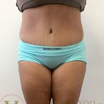 Tummy Tuck Before & After Patient #4253