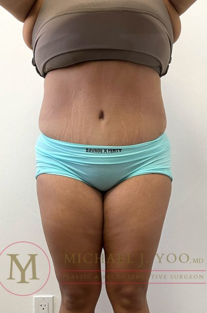 Tummy Tuck Before & After Patient #4253