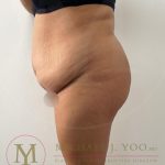 Tummy Tuck Before & After Patient #4253